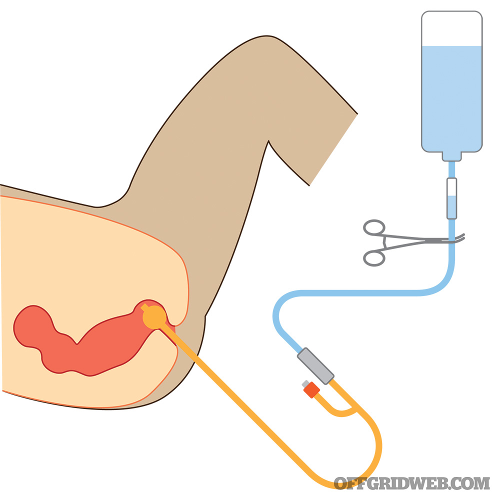 The Basics of IV Fluids for Emergency Scenarios