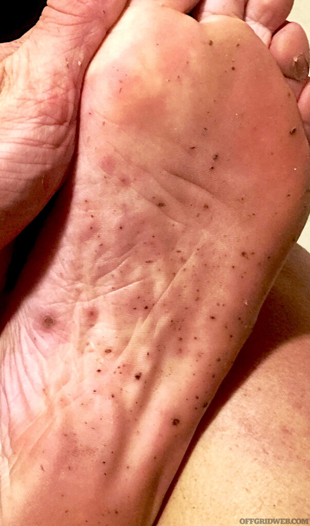 Photo of the bottom of Melissa Millers foot which has been aggressively bitten by insects.