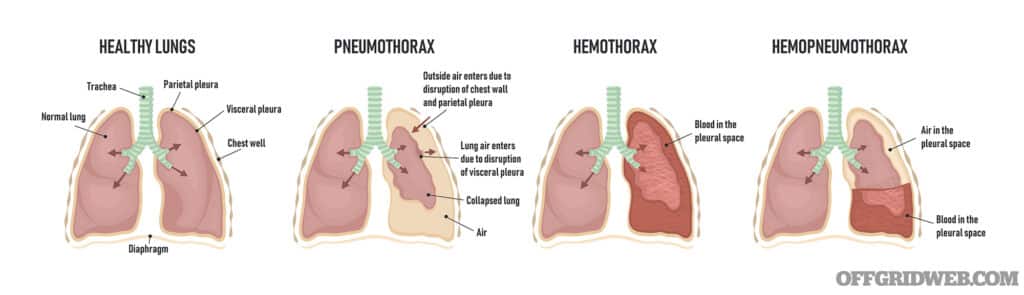 Diagrams displaying varying lung conditions.