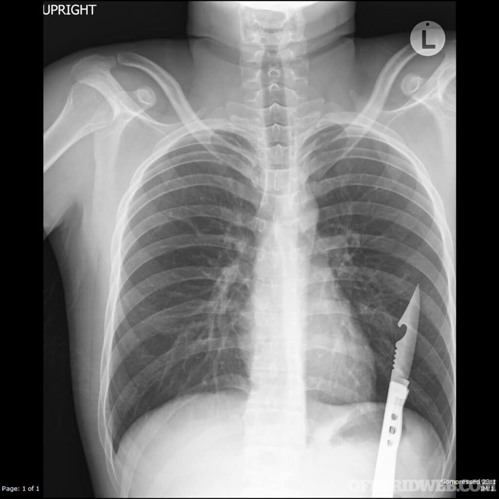 Chest X-ray of a stab wound with knife in place. If an object has impaled the chest, it’s generally advisable to leave it there until the patient reaches a hospital. Removing it may make the situation much worse.