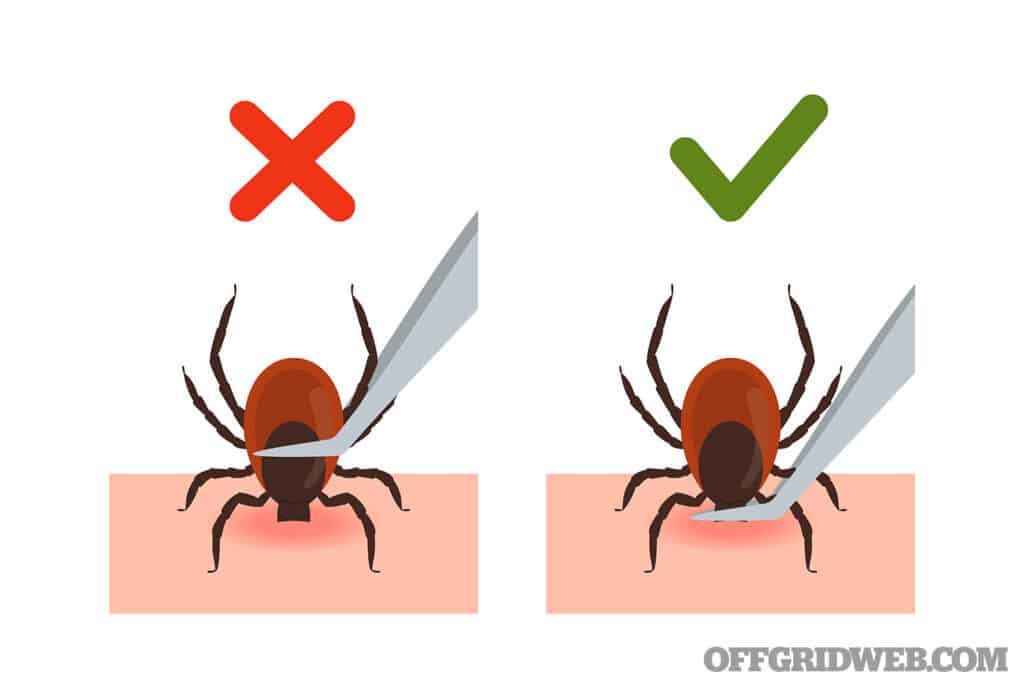 image of tick removal