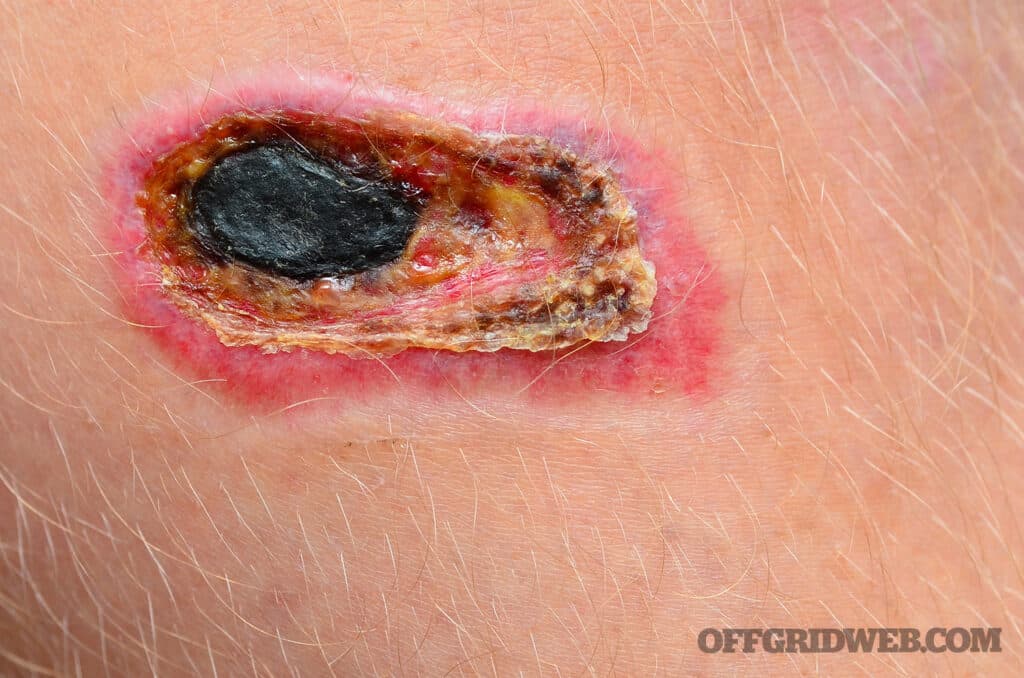 image of a brown recluse spider bite